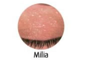 Milia-Blemish Removal