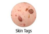 Skin-Tags-Blemish Removal