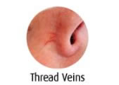 Thread-Veins-Blemish Removal