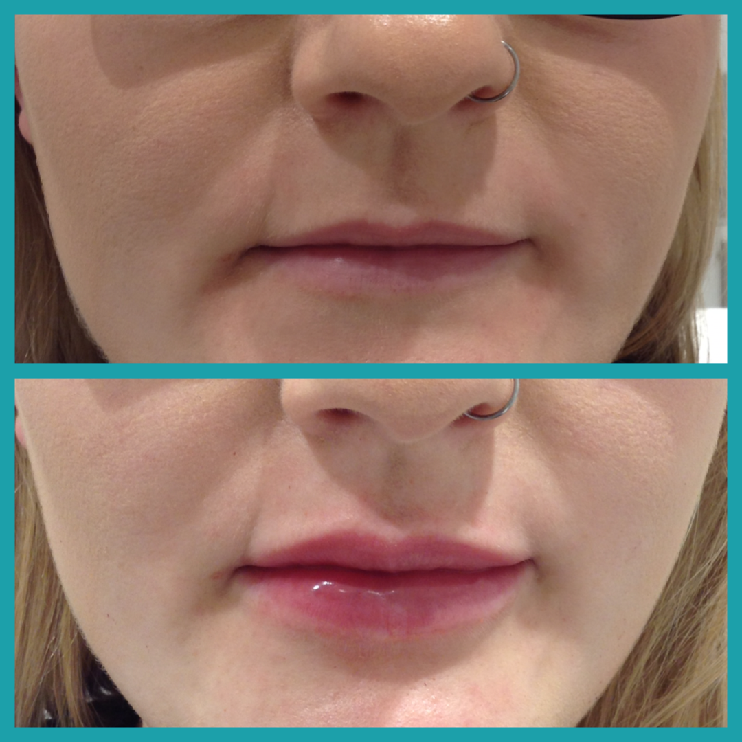 Before and after natural lip filler The Skin Nurse