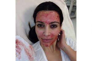 Kim Kardashian after micro needling 