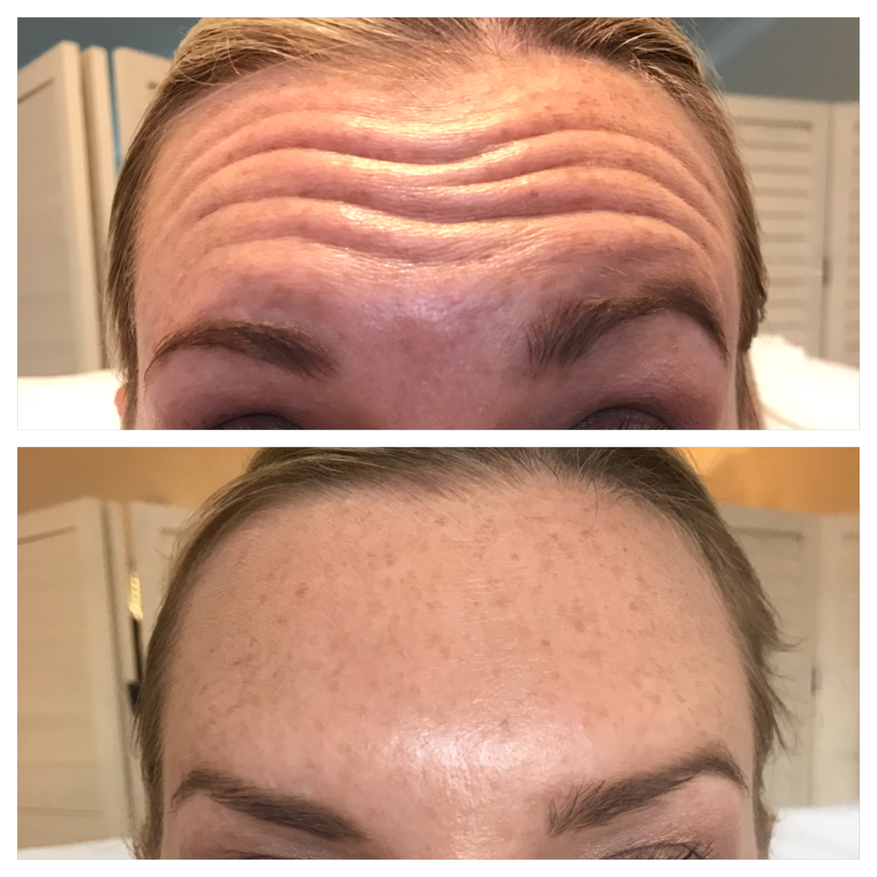 before and after botox forehead The Skin Nurse