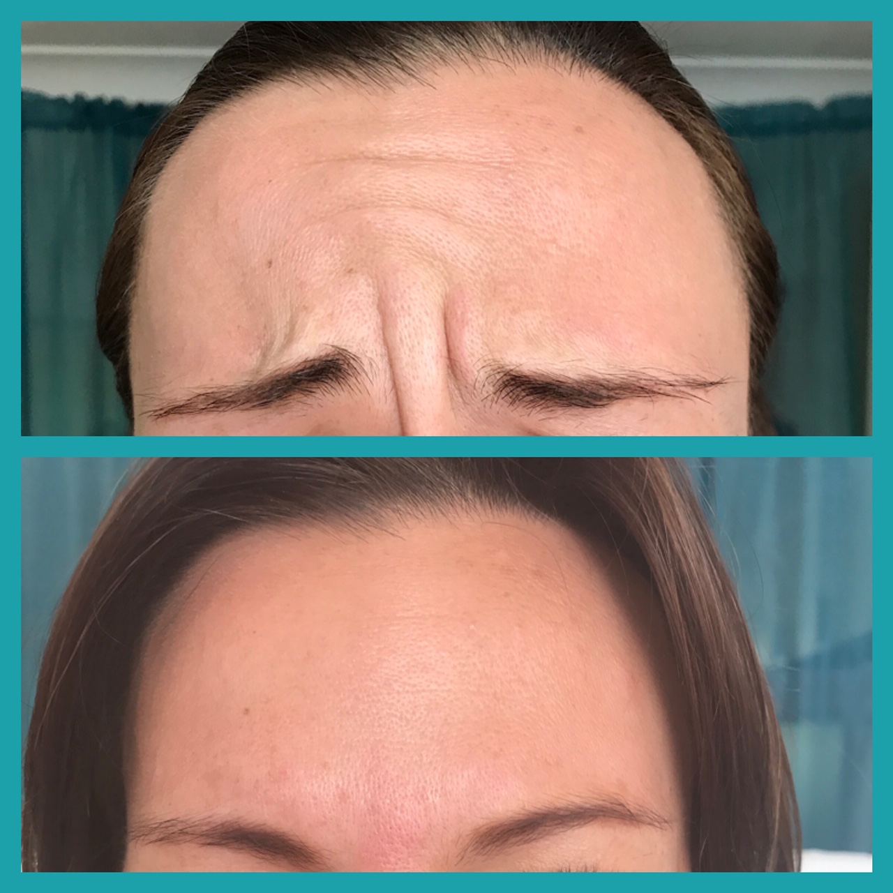 before and after botox frown area The Skin Nurse