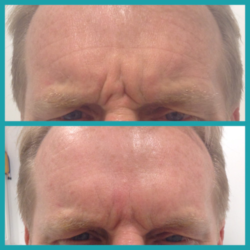 botox for men frown lines treated with botox