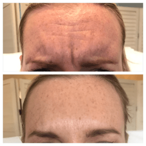 Botox for frown lines before and after The Skin Nurse
