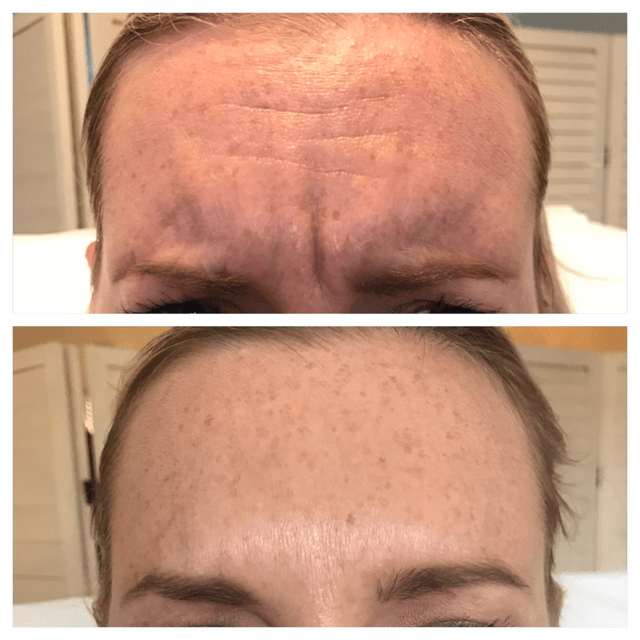 Botox for frown lines before and after The Skin Nurse