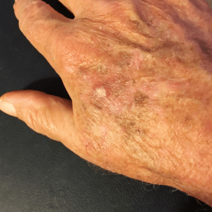 Cryotherapy lesion removal with the skin nurse Teddington(6)